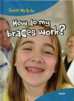 How do my Braces Work?