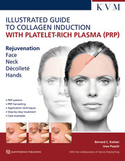 Illustrated Guide to Collagen Induction with Platelet-Rich Plasma (PRP)/Bildatlas Kollageninduktion mit Platelet Rich Plasma (PRP)
