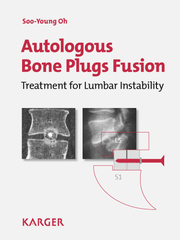 Autologus Bone Plugs Fusion