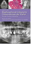 Bisphosphonat-induzierte Osteonekrose der Kiefer