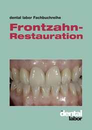 Frontzahn-Restauration