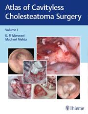 Atlas of Cavityless Cholesteatoma Surgery, Vol 1